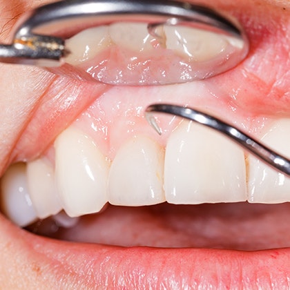 periodontal treatment in action