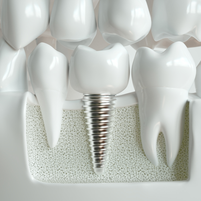 dental implant model in jaw