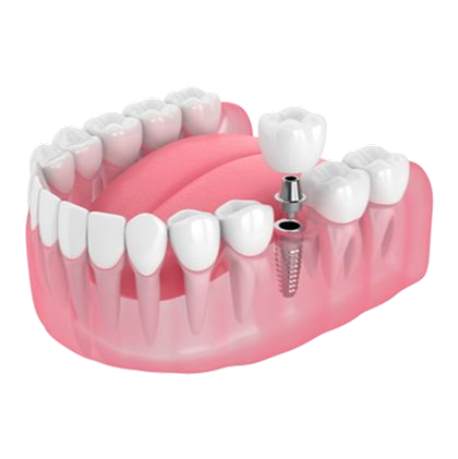 Single dental implant