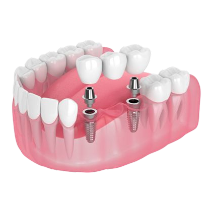 Implant-supported bridge