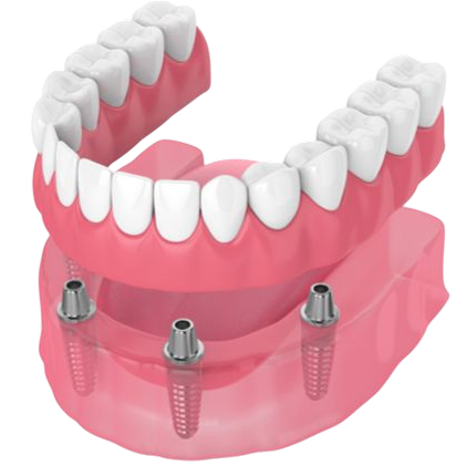 Implant-supported denture