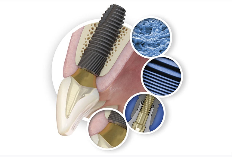 ASTRA TECH Implant System™ EV Implants illustration
