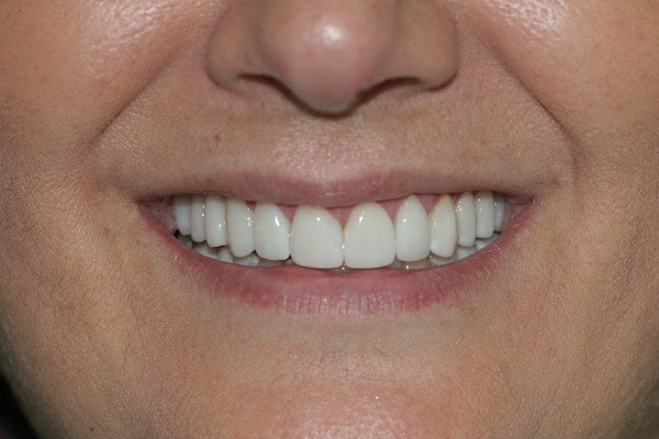 Delany Dental Care patient after a Smile Makeover