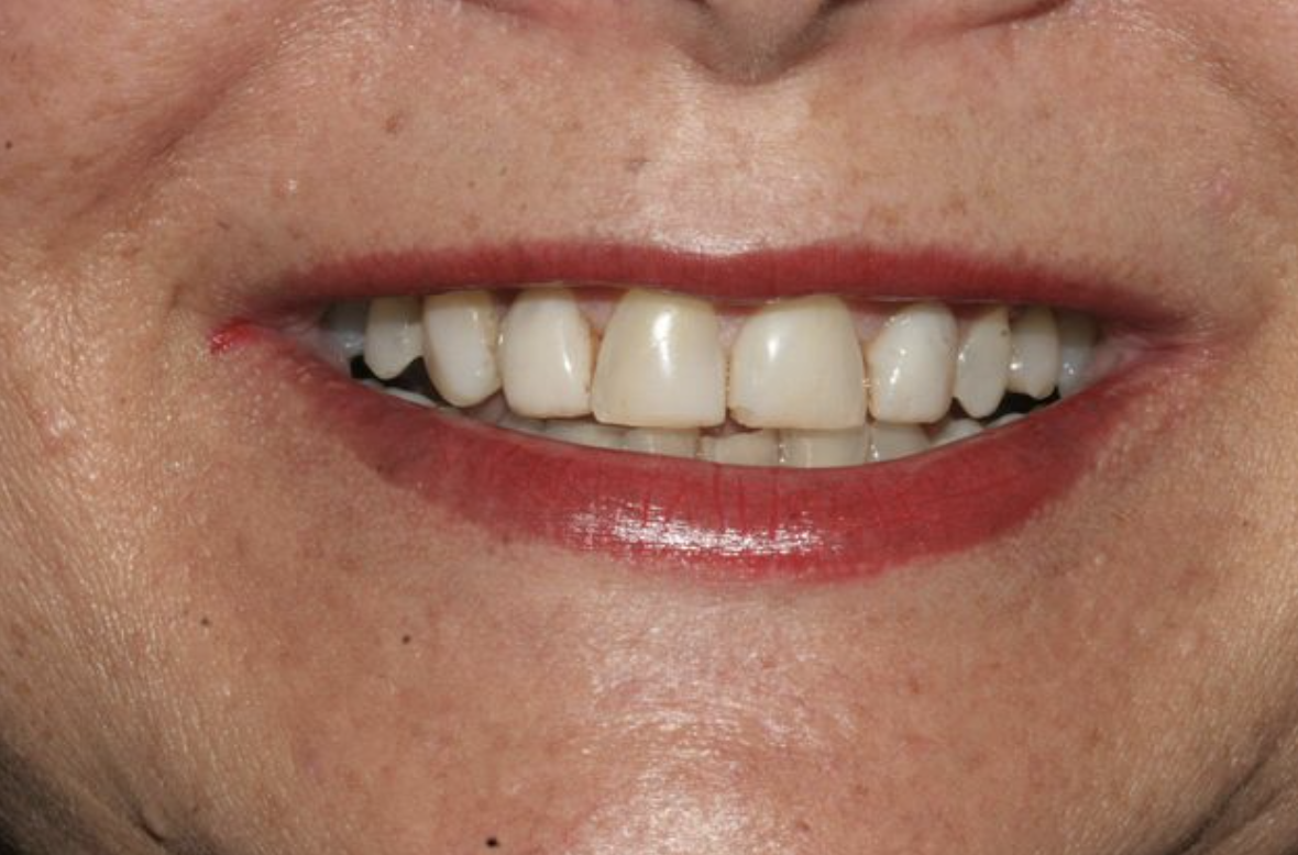 Delany Dental Care patient before treatment