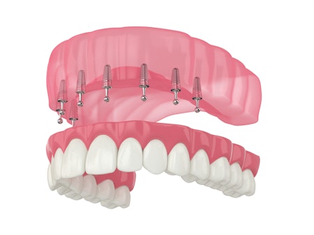 Illustration of snap-on dentures