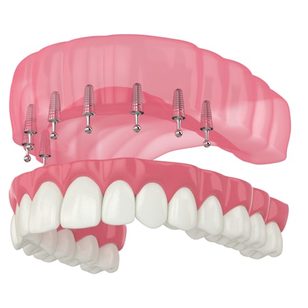 Illustration of snap-on dentures