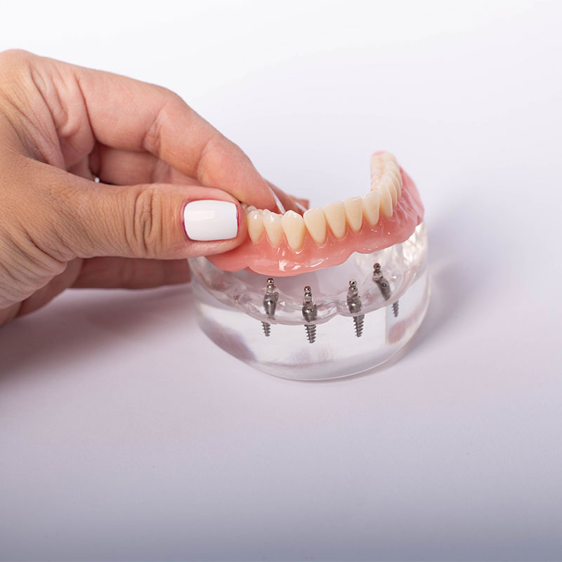Person placing implant-supported dentures on a plastic gum model