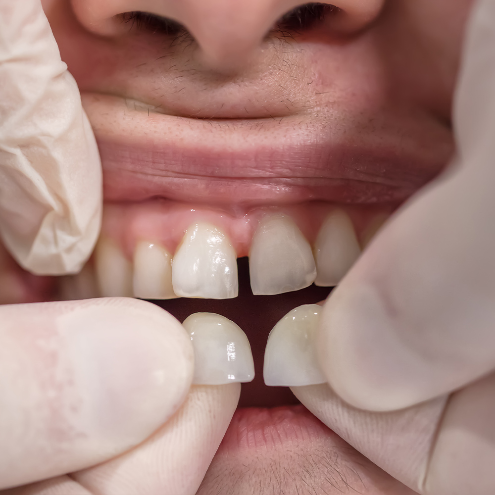 a person being fitted with two frontal veneers