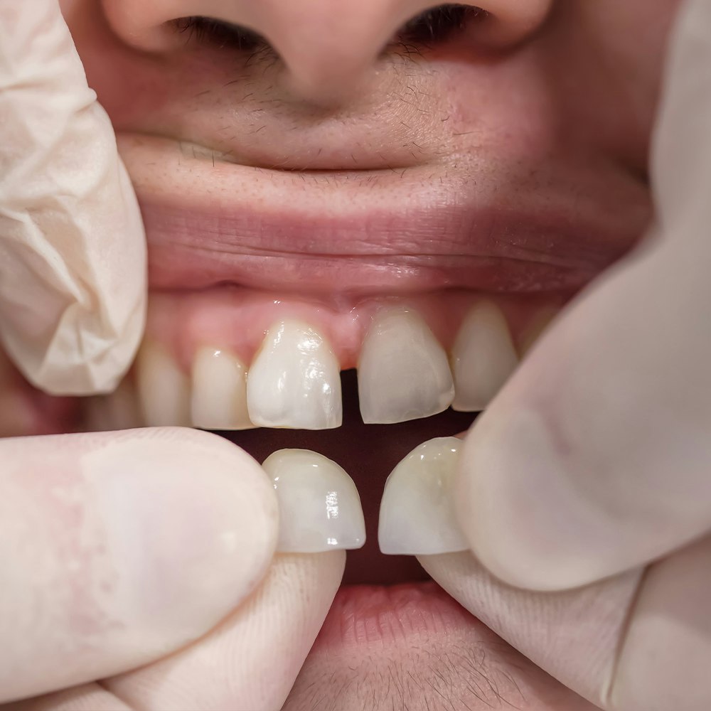 a person being fitted with two frontal veneers