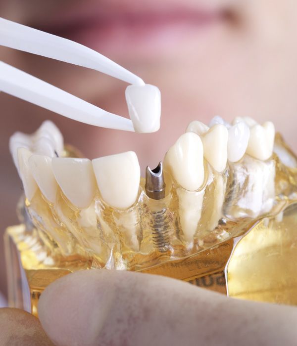 Photo of a crown held over a dental implant in a mold