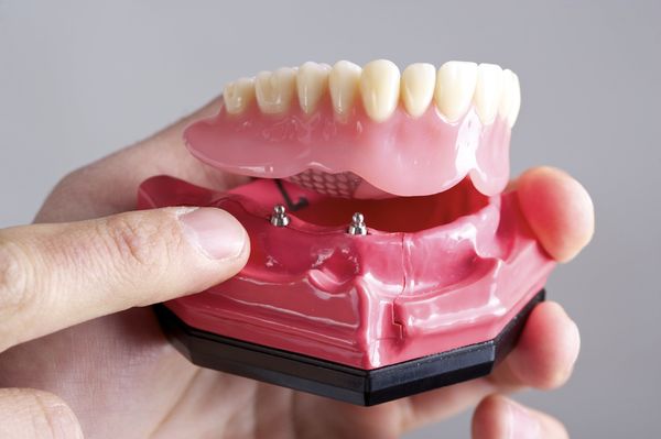 Photo of a denture