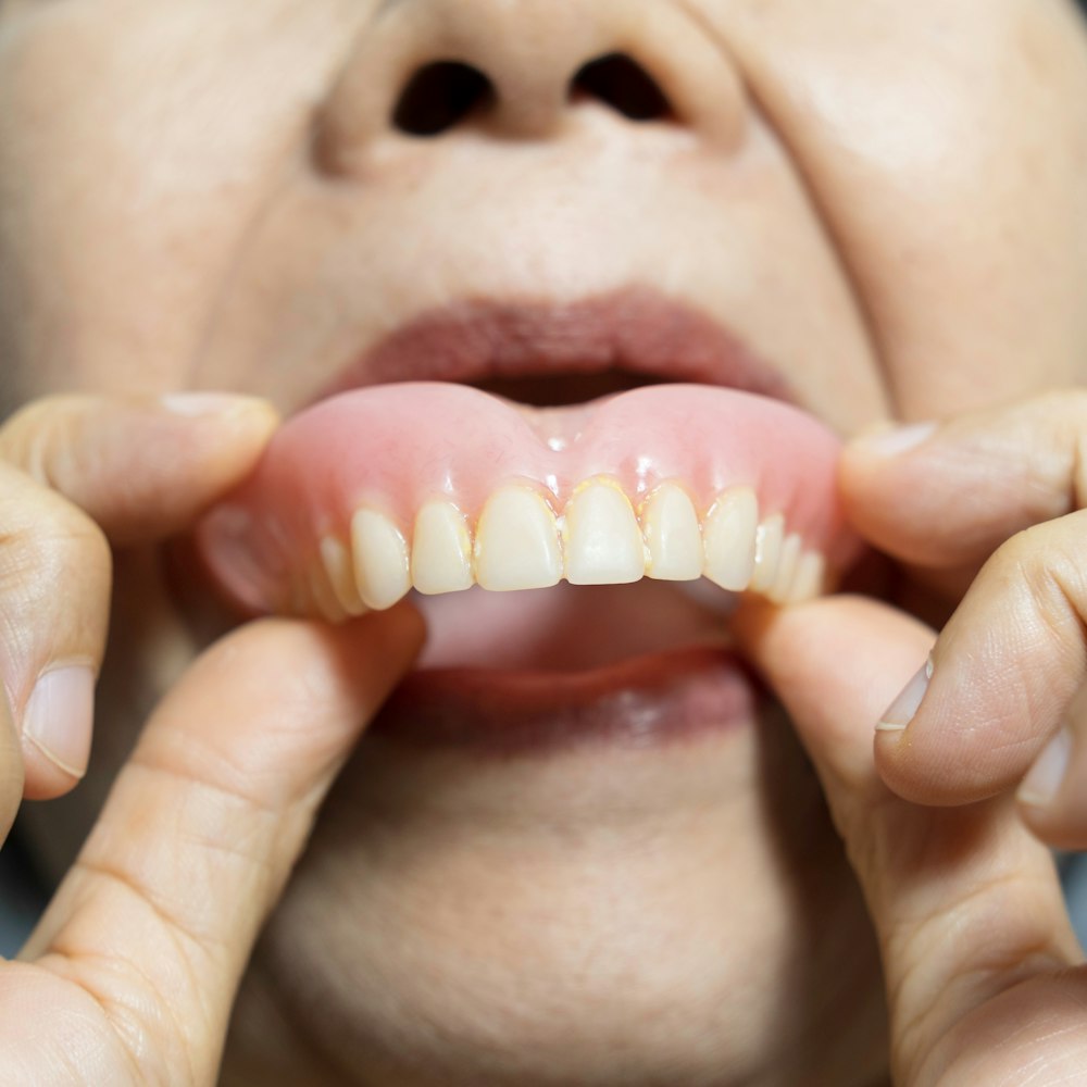 Photo of a upper denture