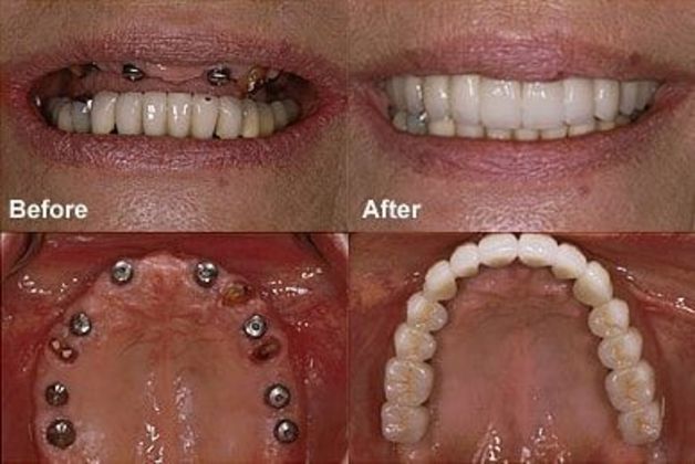 Before and after dental implant denture