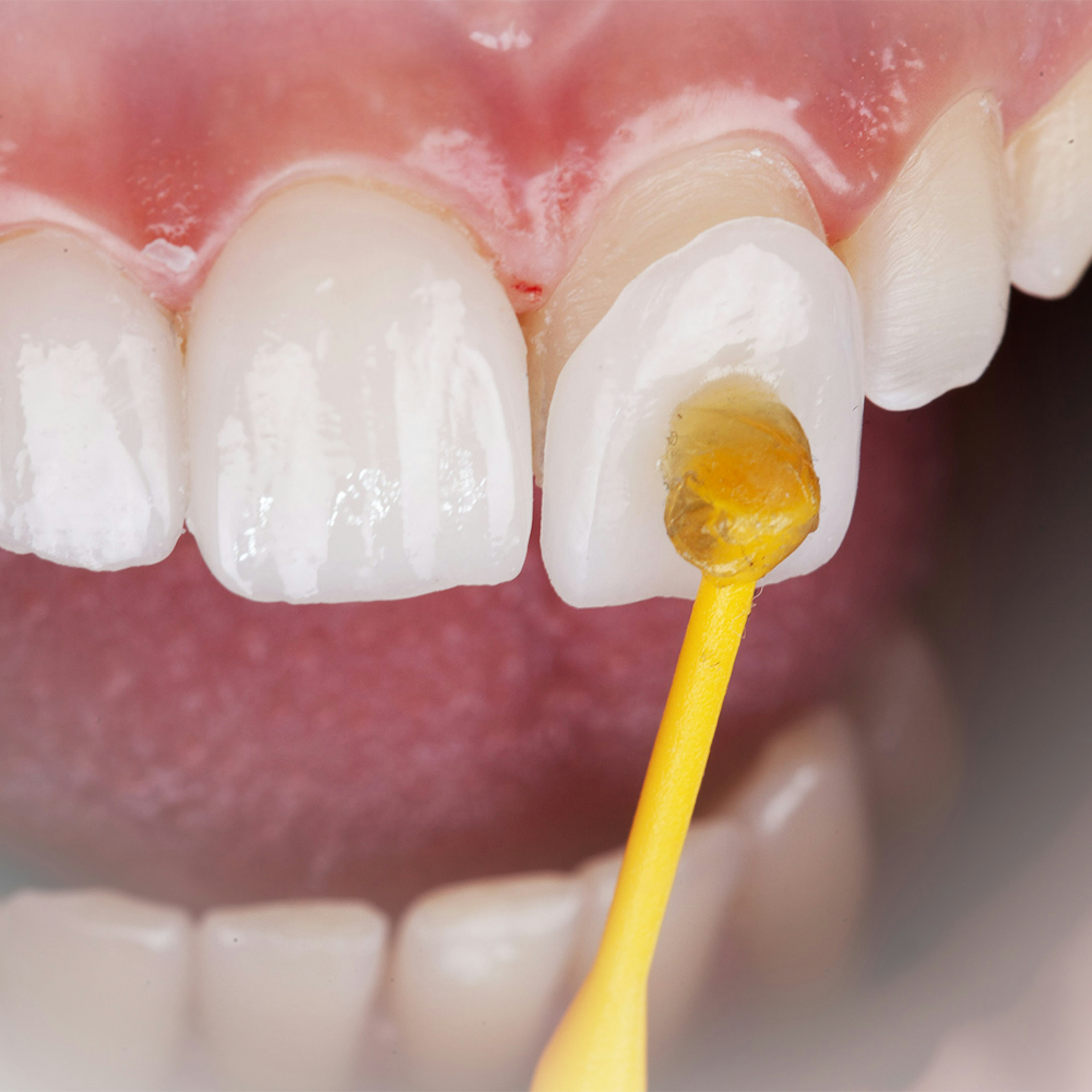 Porcelain veneer being placed