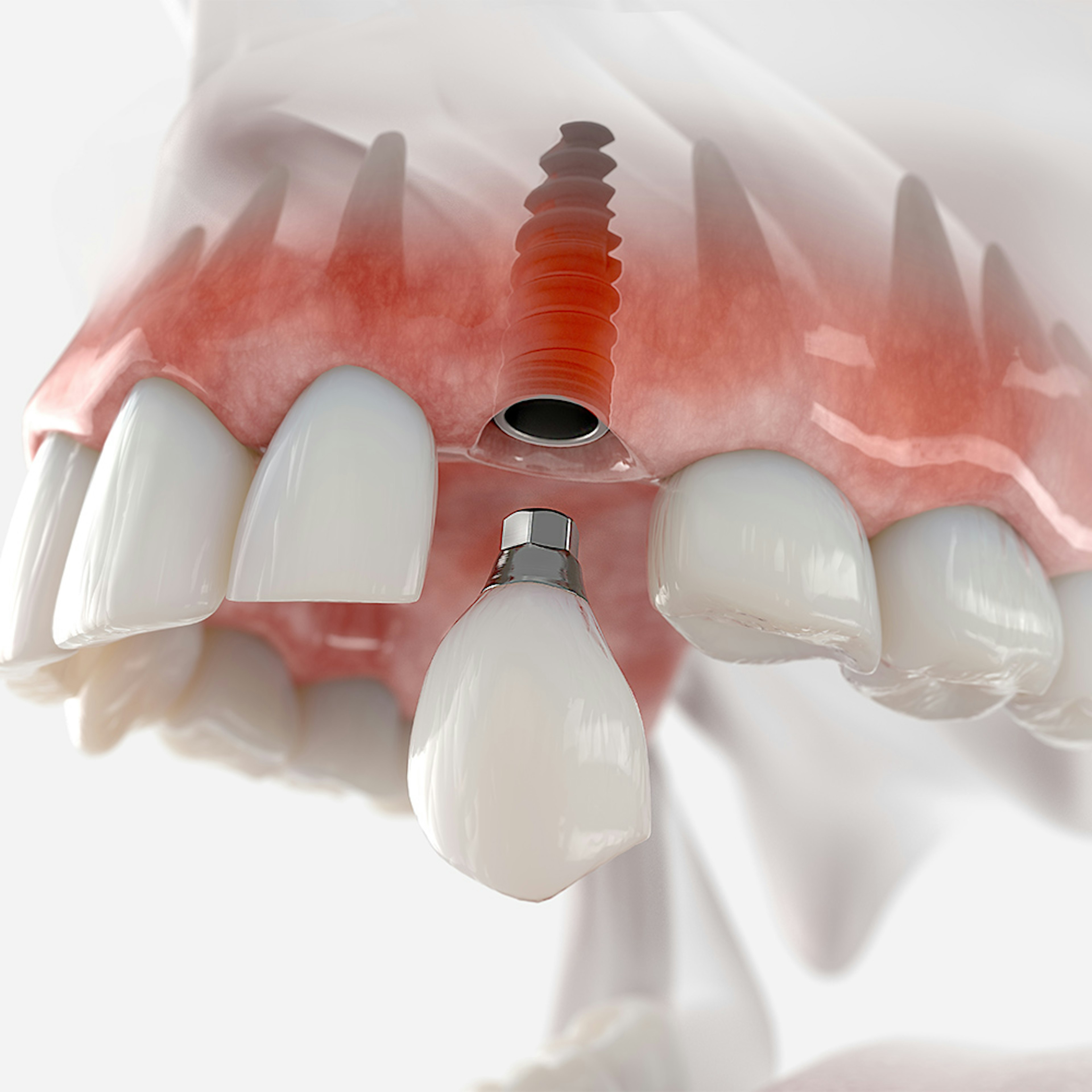Dental implants being inserted in the jaw