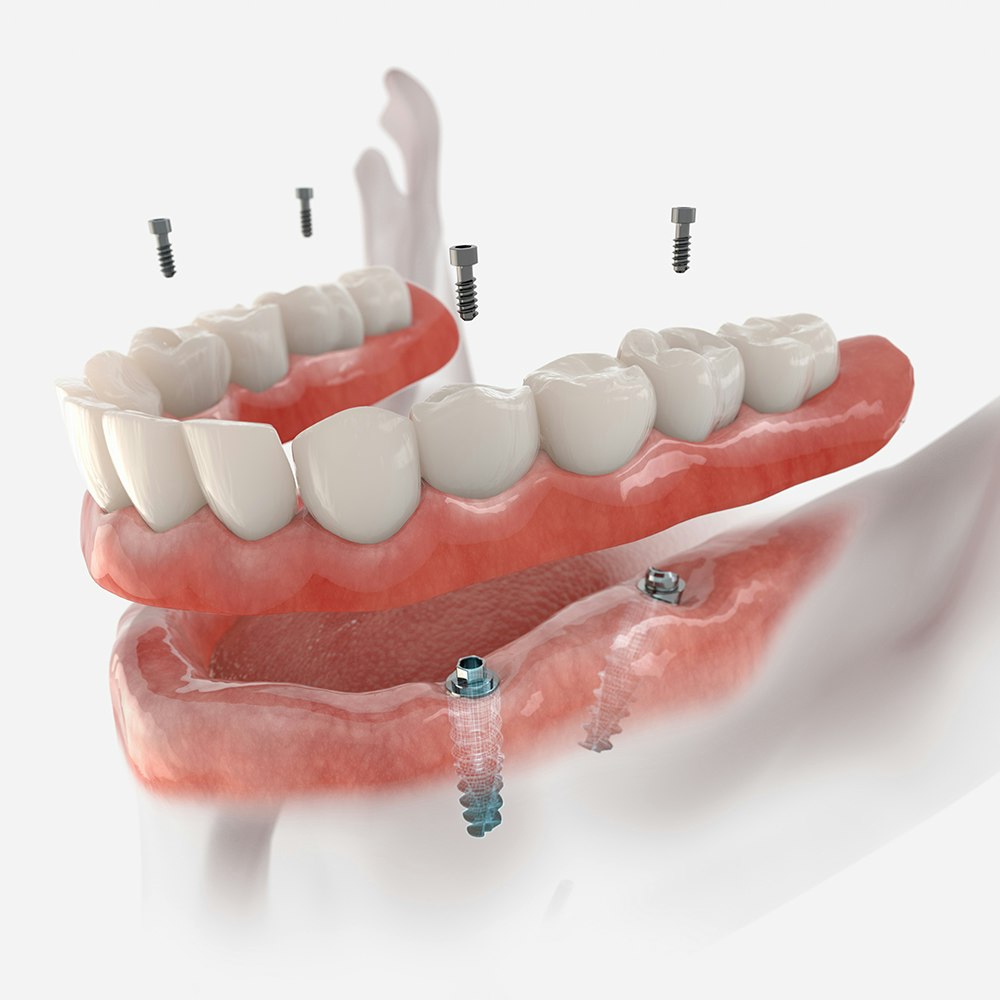 All-on-4 denture and implants