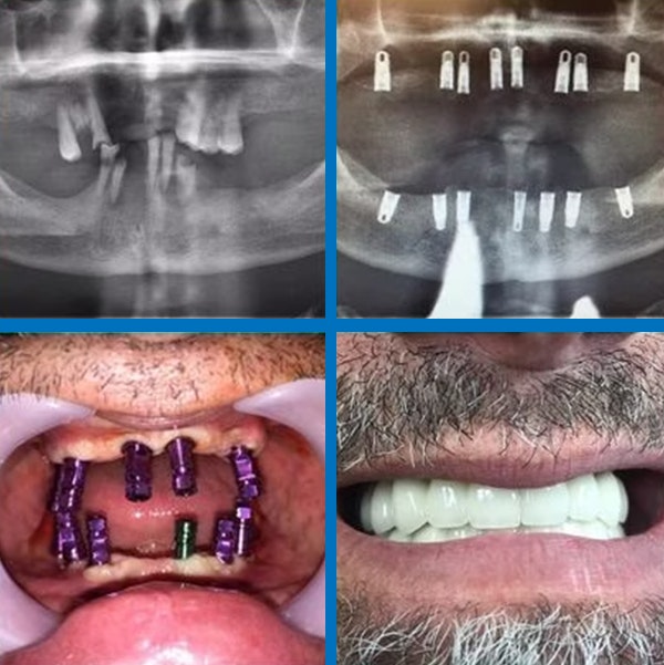 Dental x-rays and patient before and after implants