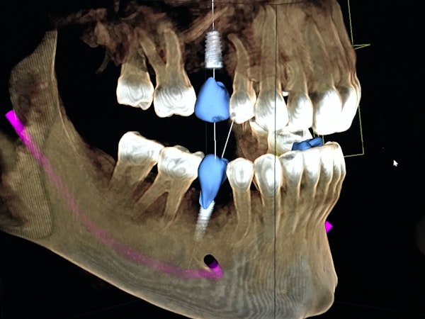 Dental Implants X-ray