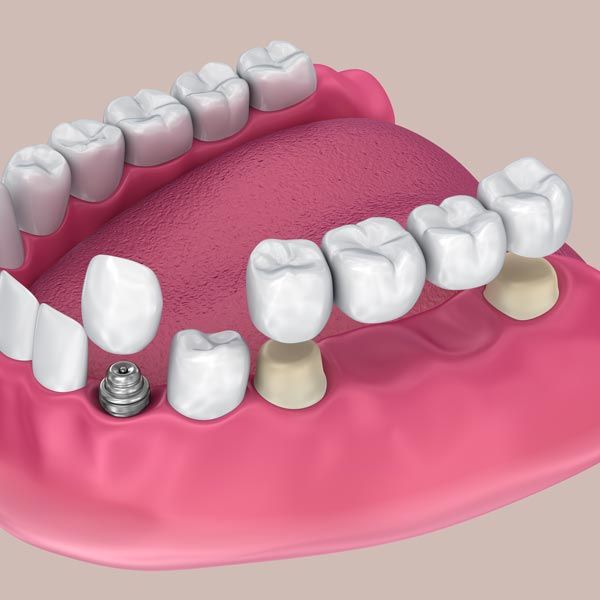 Dental bridge supported by implant and two natural teeth on lower jaw model