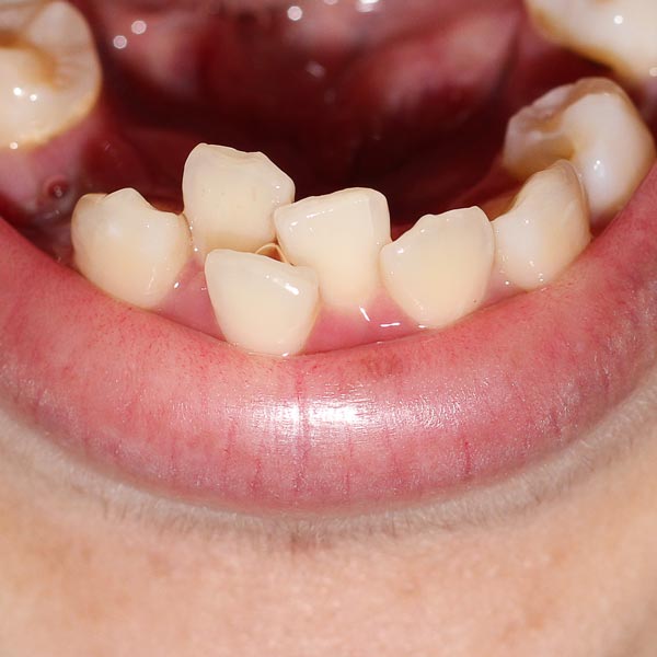 Crowded lower teeth