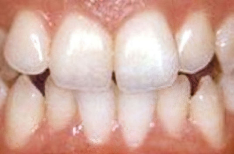 Dr. Joseph T. Mormino's patient before teeth whitening