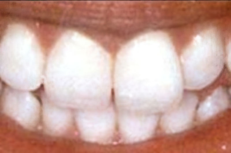 Dr. Joseph T. Mormino's patient after teeth whitening
