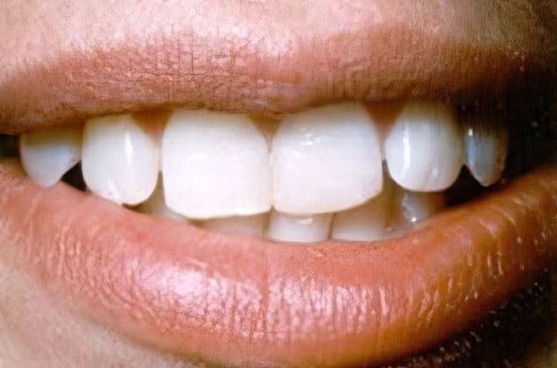 Dr. Joseph T. Mormino's patient after dental bonding