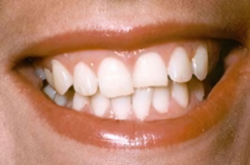 Dr. Joseph T. Mormino's patient before dental bonding