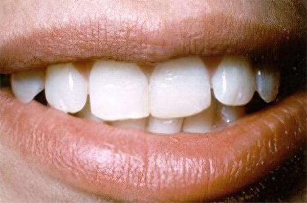 Dr. Joseph T. Mormino's patient after dental bonding