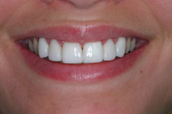 After cosmetic treatment