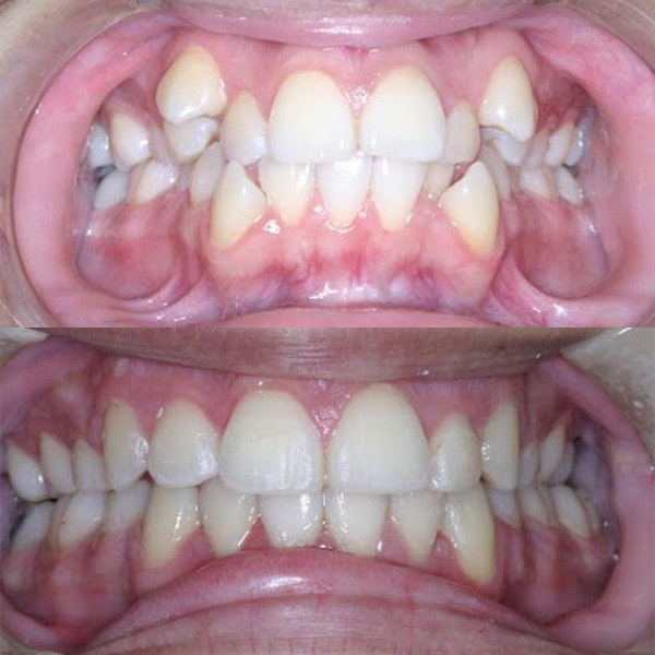 Before and after Invisalign results