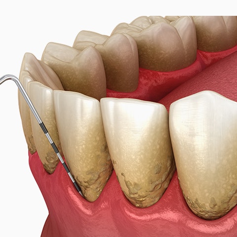 Periodontitis