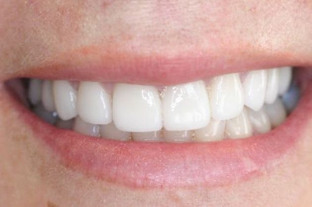 After smile makeover