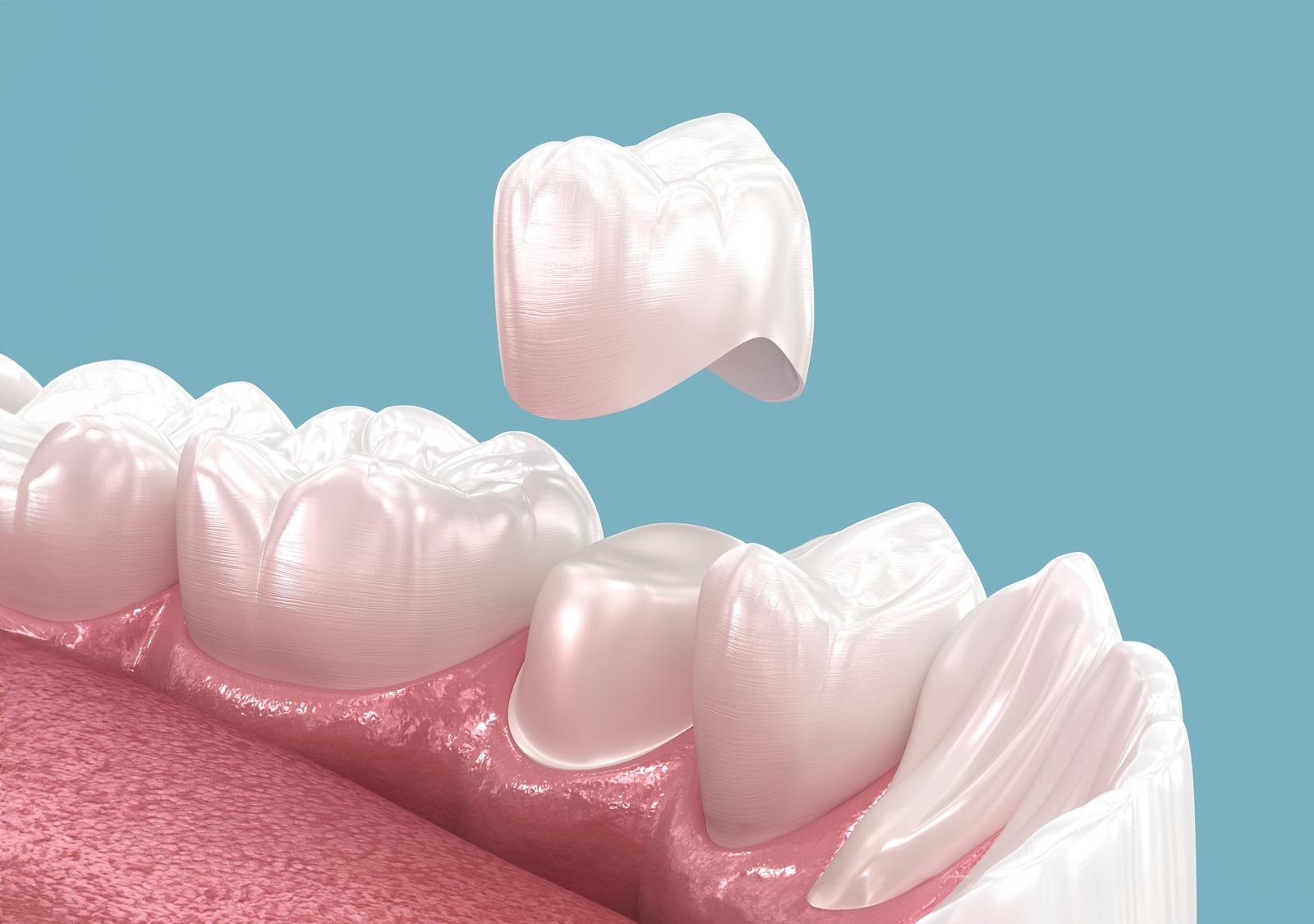 Traditional dental crown