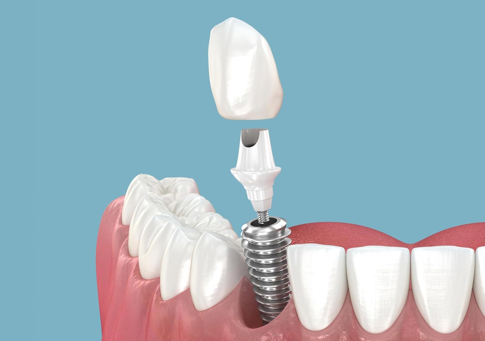 Implant-supported dental crown