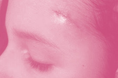 Scar on woman's face