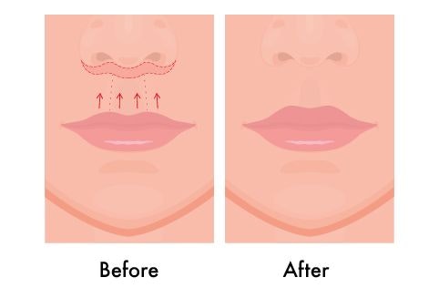 lip lift illustration