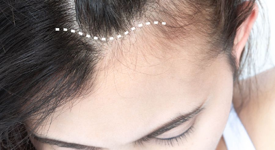 Surgical line on woman's forehead