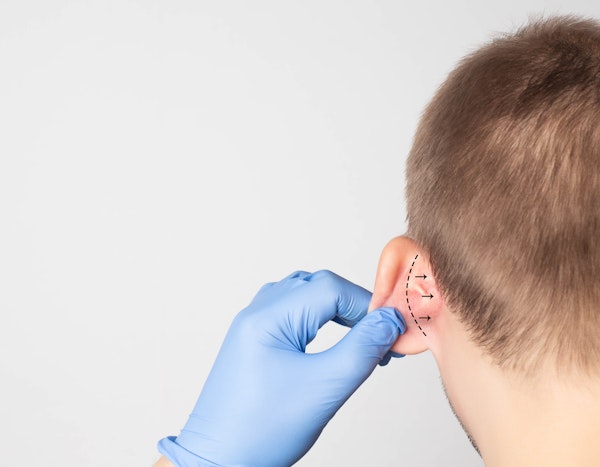 Boy about to have ear reduction