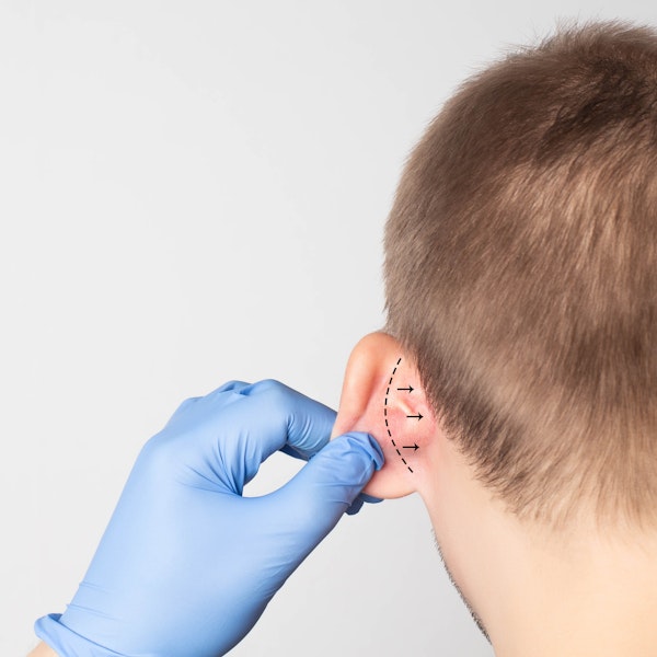 Boy about to have ear reduction