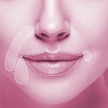 Restylane possible injection sites