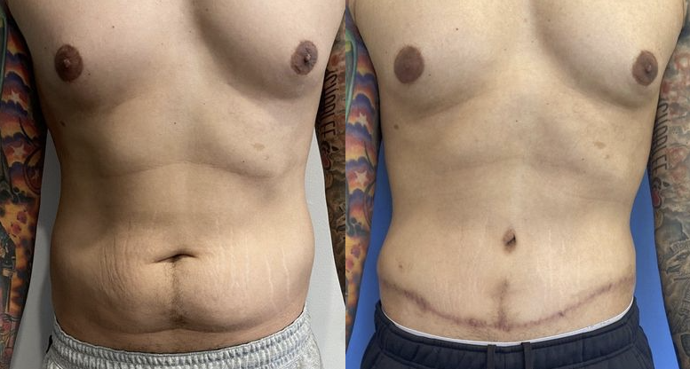 mini tummy tuck