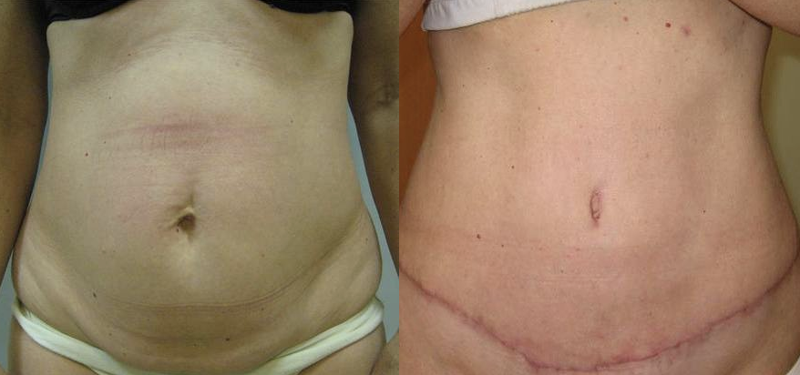 Full tummy tuck