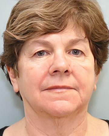 before facelift with Anya Kishinevsky, M.D.