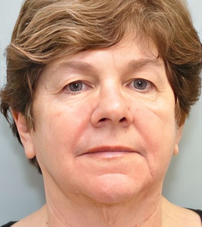 before facelift with Anya Kishinevsky, M.D.