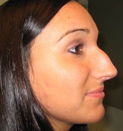 Dr. Kishinevsky's patient before rhinoplasty
