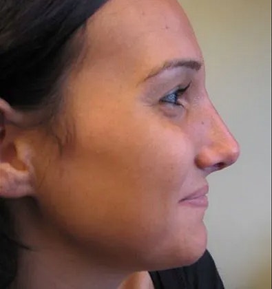 Dr. Kishinevsky's patient before rhinoplasty
