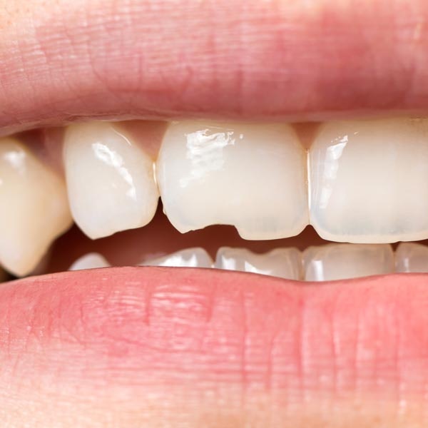 Chipped tooth