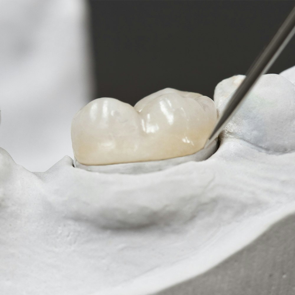 Close-up of an onlay resotration