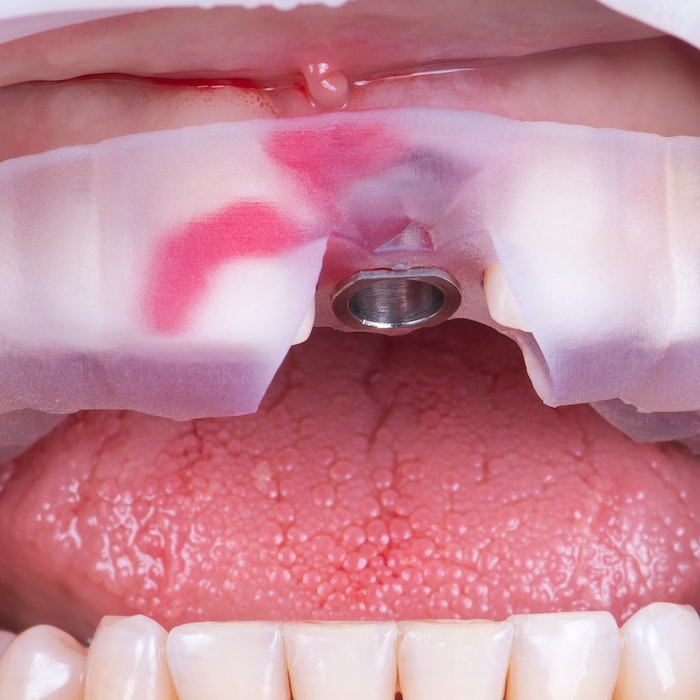 placing a dental implant